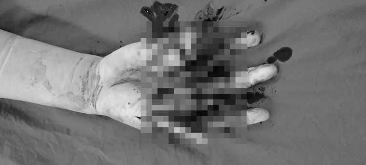 傷者右手掌多處變形碎裂。民眾提供