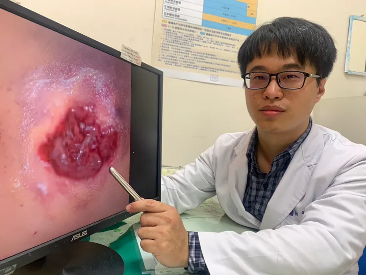 台中醫院家醫科旅遊門診醫師蕭誌毅說明，去年參加媽祖遶境遭鞭炮炸傷到院急診的案例。台中醫院提供