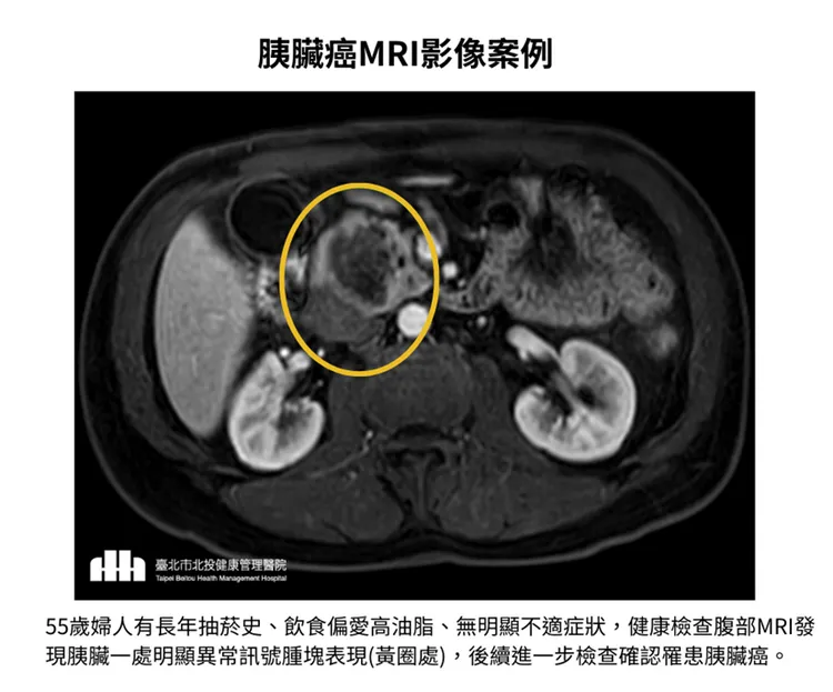 55歲婦人罹患胰臟癌。北投健康管理醫院提供
