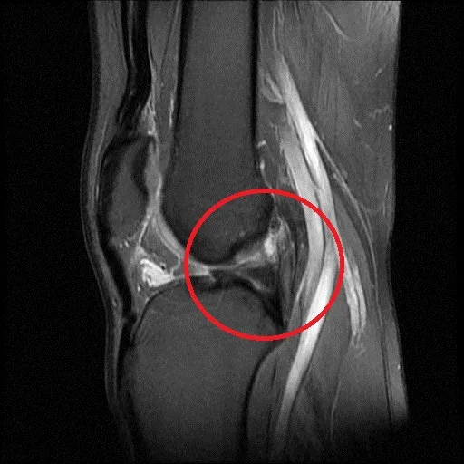 患者因十字韌帶斷裂(紅圈處）險些斷送籃球夢。院方提供