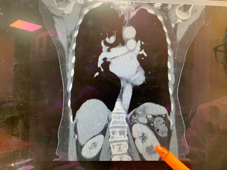 「單側雙套集尿系統」在臨床上並不少見，發生率從百分之一到千分之八不等。台中醫院提供