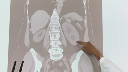 台中62歲女健檢發現竟有3顆腎 別高興太早!這原因尿道易感染