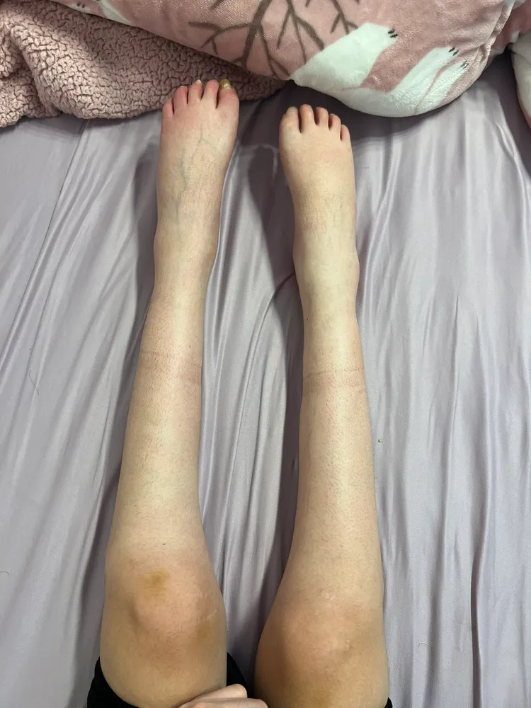 中嶋不避諱讓大家知道自己的身體狀況，有時會在社群上貼出自己的雙腿情況。