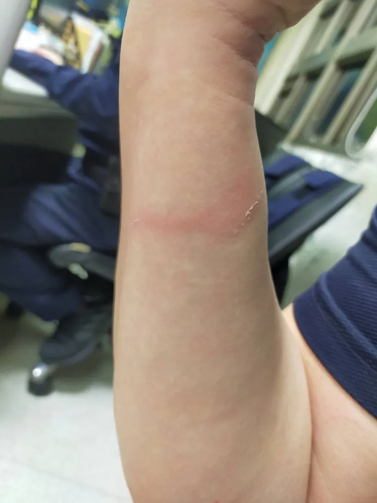 警員手臂遭嫌犯割傷紅腫。翻攝畫面