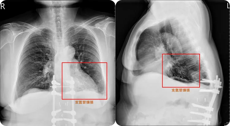 患者左下肺部的支氣管嚴重擴張，出現各種不適症狀。亞大附醫提供
