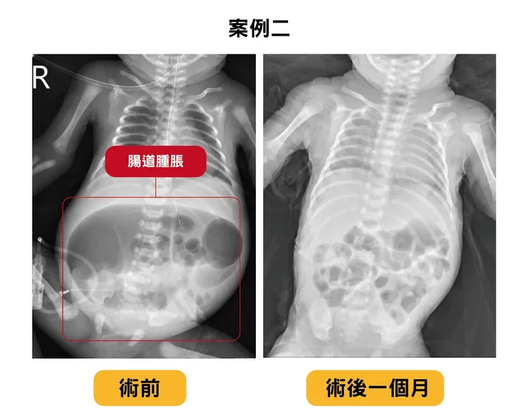 第2例寶寶出生時僅1700公克，經手術給予足夠營養支持，一個月後健康出院時體重已達到2300公克。中醫大附醫提供
