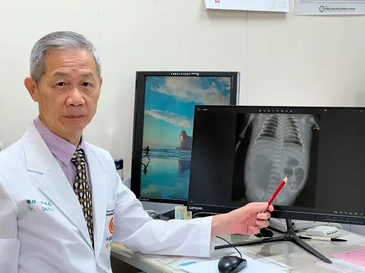 新生兒先天性腸道問題32週緊急剖腹產 出生第2天精準手術救命