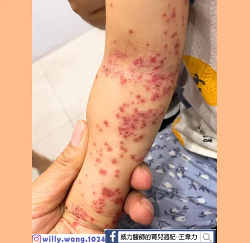 腸病毒流行期!營養師推薦「這樣吃」好吞嚥、冰鎮降溫