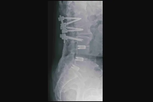 自費30萬脊椎手術仍無法行走　他改健保給付術後「自行走進診間」