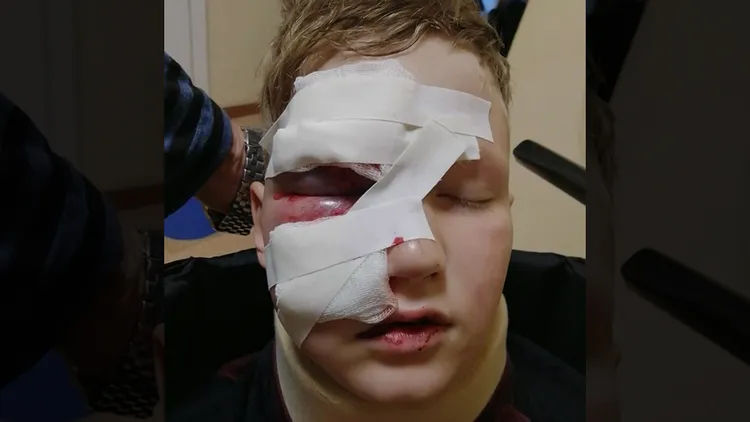 男童臉部被桶子射傷，被送醫治療。翻攝自X