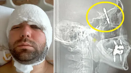 暴力植牙!牙醫疑用力過猛 金屬植體穿透病人頭骨嵌入大腦