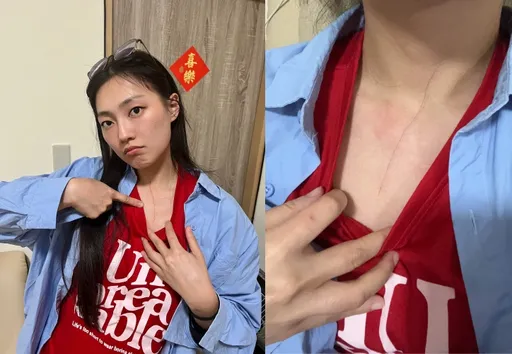 家裡養老虎嗎? A-Lin愛徒遭「家暴」胸口抓出10公分血痕
