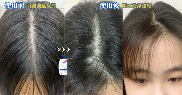 ▲ 夏季整天在外，頭皮屑、扁塌、條碼瀏海全找上門(圖左)，使用海倫仙度絲後能讓頭皮維持72小時乾爽(圖中圖右)，頭髮清爽蓬鬆。