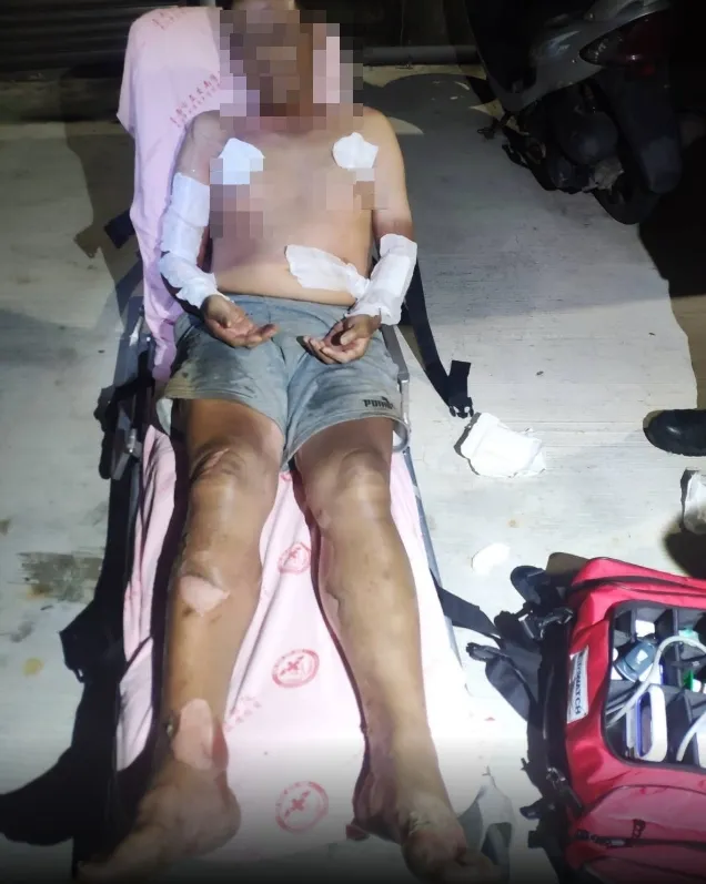 男子全身有77%燒燙傷。讀者提供