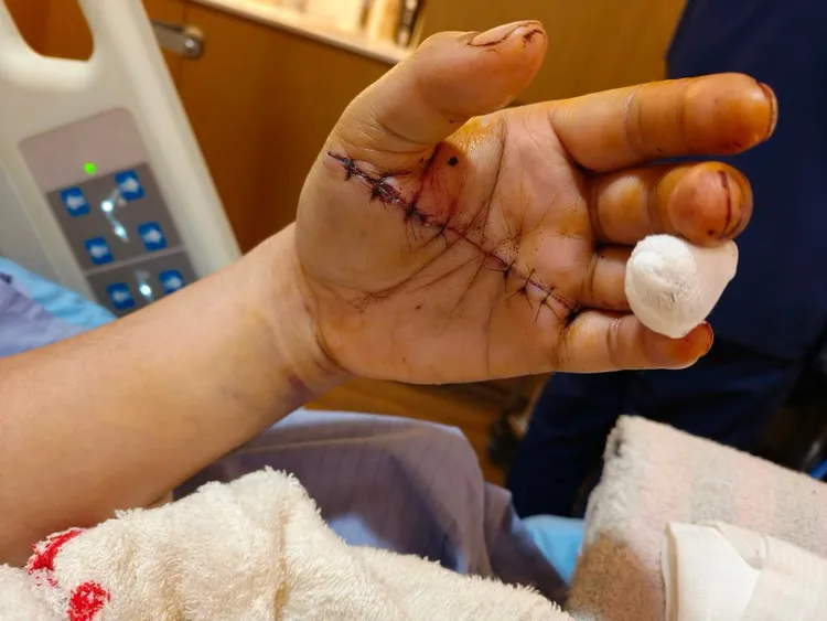 檳榔攤老闆手被砍傷。投訴人提供