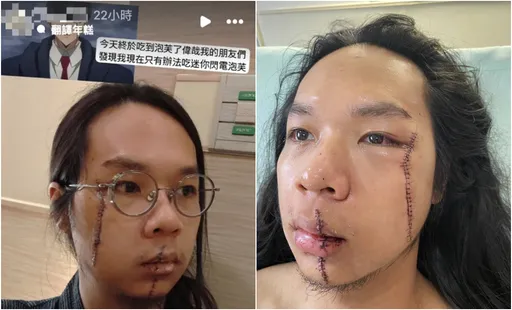 中捷「長髮哥」臉留下2大條疤有救了 一出院就到愛爾麗恢復帥氣臉龐