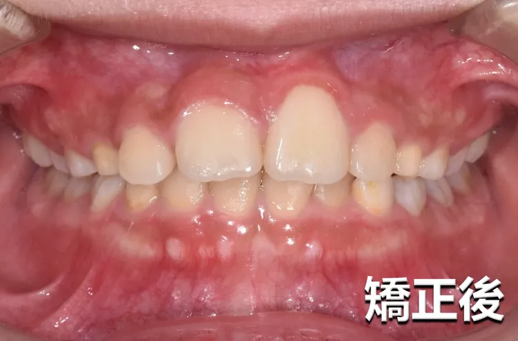 醫師將阻生上顎正中門牙以開窗手術方式露出，後續在上顎局部牙齒黏上矯正器，以矯正線牽引阻生牙。亞大附醫提供