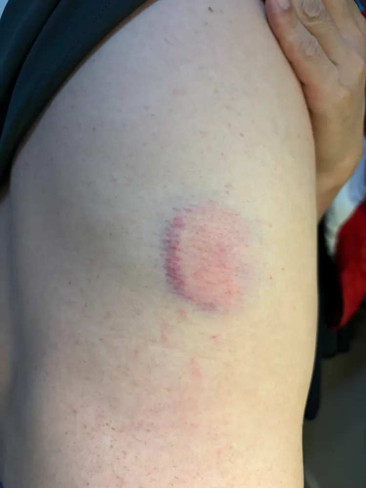 蘇炳憲傷勢，民視提供