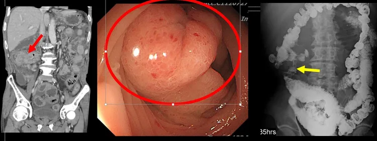 患者半年來體重掉了10公斤，最近3個月更3度腸阻塞送急診，竟是腸子感染結核菌。台中醫院提供