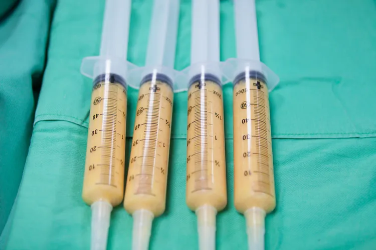 補脂的重要關鍵，是脂肪細胞的「存活率」。