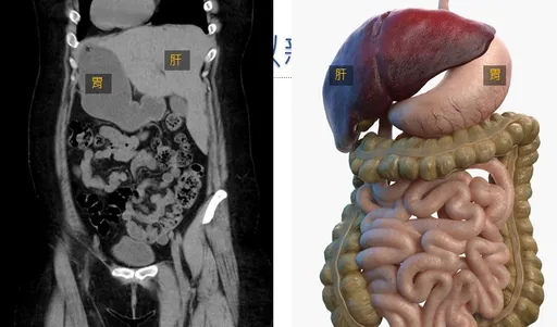 罕見！台中35歲女「鏡面人」內臟左右相反　高難度手術剷肉20公斤