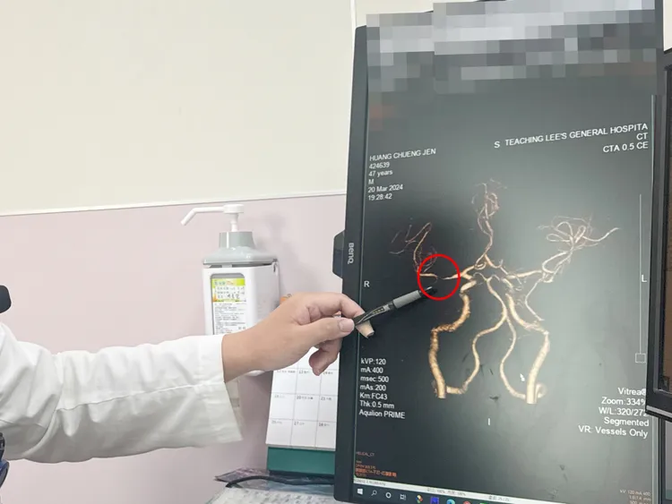 黃姓患者中風腦阻塞超過12小時才送醫，所幸旁邊的細微小血管還有協助送血運作，讓他腦細胞還能存活。李綜合醫院提供
