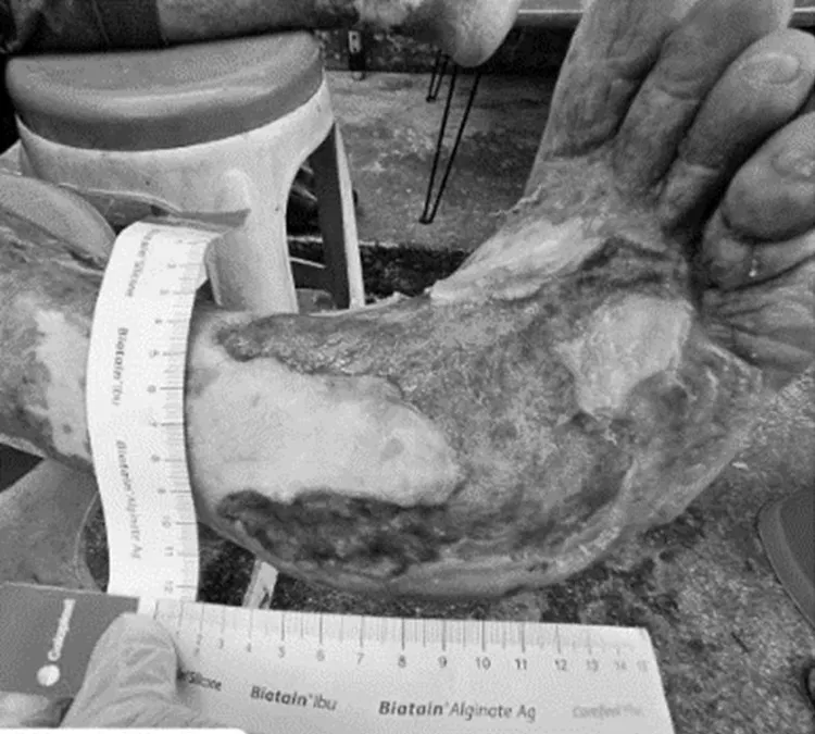 沈伯伯使用銀離子敷料，原本惡化的傷口如今好轉。奇美醫院提供