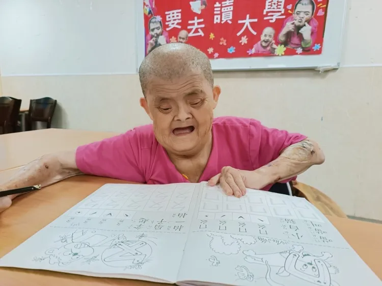 入住天鵝堡9年的阿珠，身體機能崩塌式退化，在全日型照顧後進入另一需要醫療照護的階段。喜憨兒基金會提供