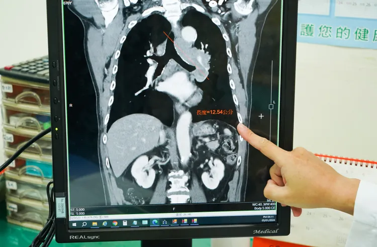 張姓阿公的癌化處，光長度就約12公分。光田提供
