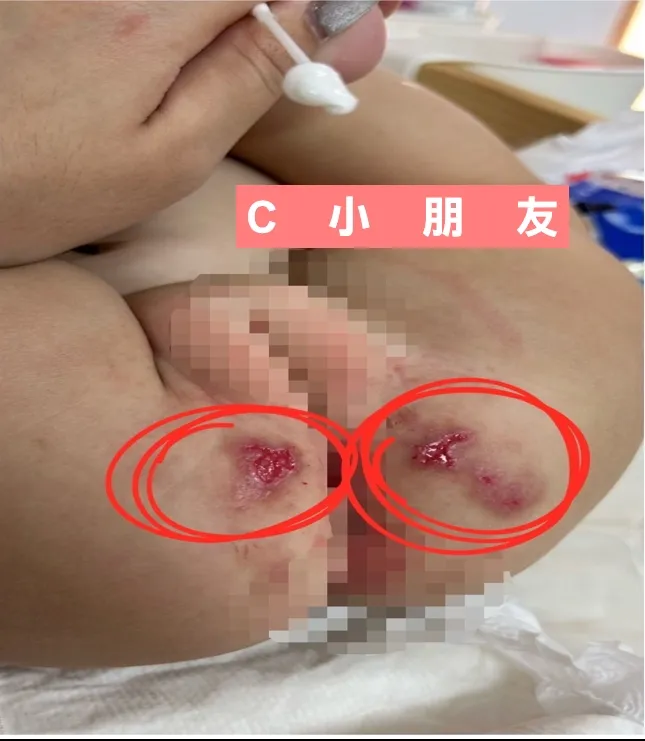 家長質疑保母未適時換尿布，導致有4名寶寶皮膚潰爛。林燕祝提供