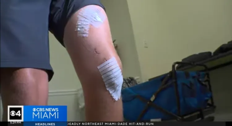 Marlin Deere Wakeman被第一條鯊魚攻擊腿部傷勢。翻攝　CBS News