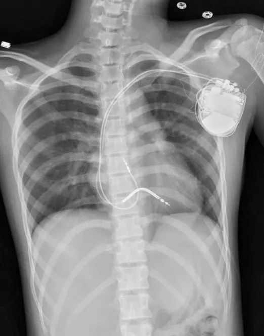 中醫大兒醫醫療團隊替小涵安裝體內去顫器，確保突發心室頻脈時，可立即電擊搶救。中醫大附醫提供