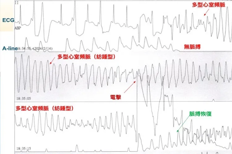 小涵入院後多次發作多型性心室頻脈，經安裝葉克膜及前後共22次電擊，才穩定狀況。中醫大附醫提供