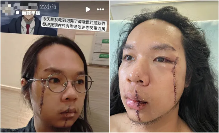 中捷長髮哥送醫治療後留下長長傷疤。翻攝當事人IG、讀者提供