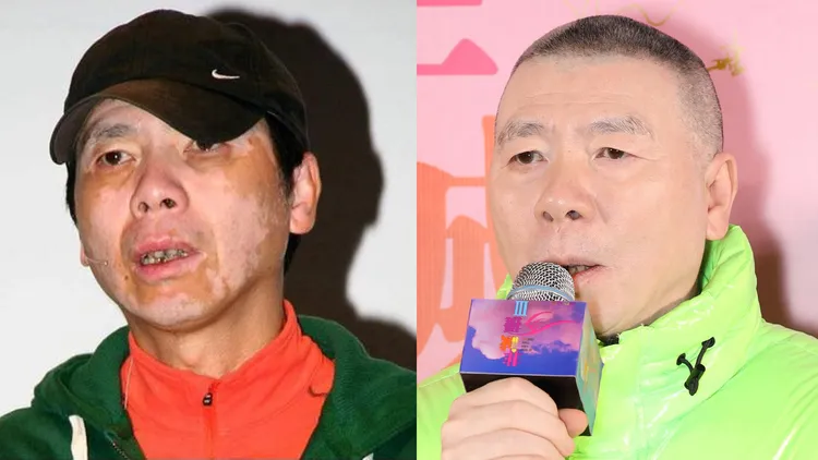 馮小剛原本臉上有不規則白斑，去年現身看不出來，網友推測因為「白完了」。翻攝網易娛樂、馮小剛電影官微