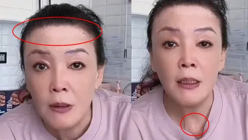 汪小菲知道嗎？66歲張蘭罹「白癜風」　額頭脖子冒白斑