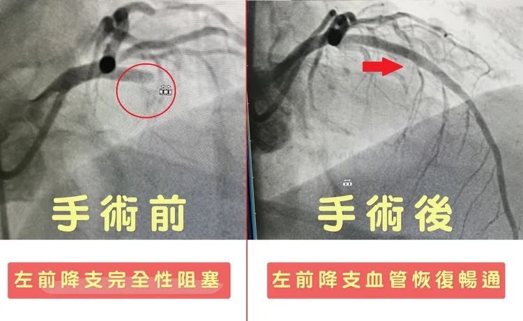 心導管手術前後對照。烏日林新提供