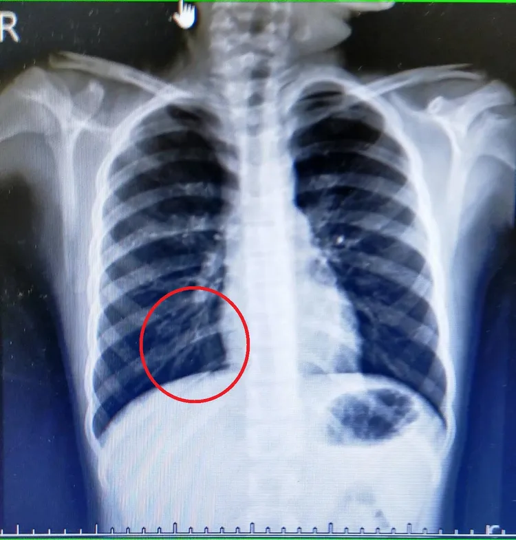 彭小妹肺部感染X光檢查。烏日林新醫院提供