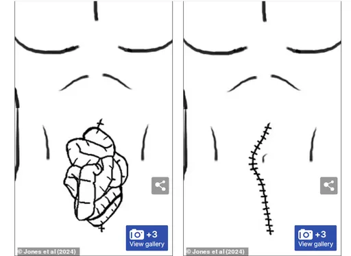 他同時起2種生理反應 「濕濕的」一看竟掉出腸子