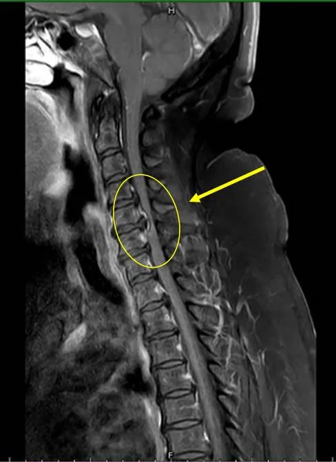 經頸部核磁共振檢查，發現患者頸椎壓迫很嚴重，立即安排頸椎融合手術來改善神經壓迫狀況。豐原醫院提供