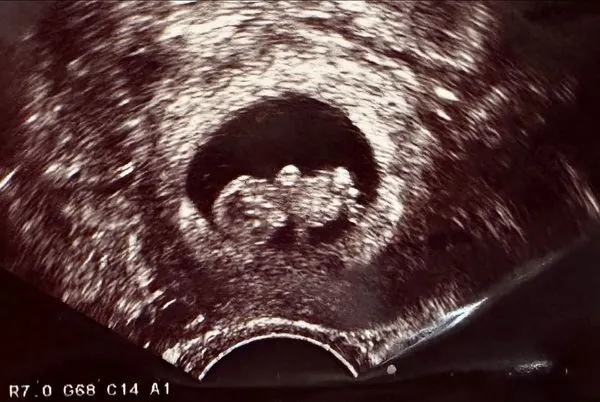 李佳穎高興宣秀超音波照。翻攝李佳穎臉書