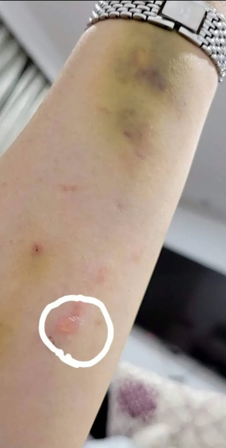 小彤做完第1次化療後，皮膚變得敏感脆弱，起了水泡。翻攝小彤臉書