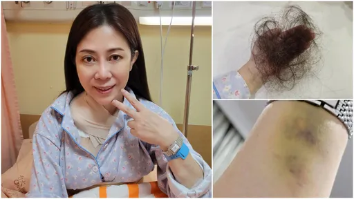 小彤抗癌最新病況曝 女星見「30公分傷口」:我心淌血