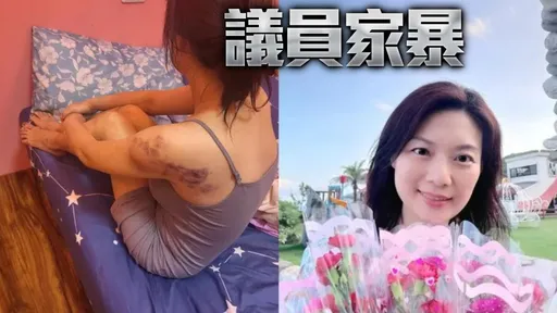 「副主席娶副主席」政治聯姻破裂！她PO傷痕照控議員：打我十幾年