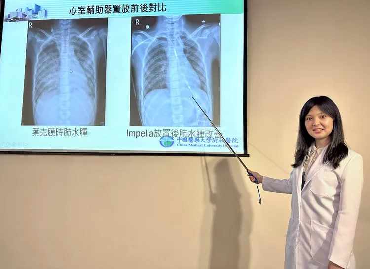 吳佳穎醫師說，少女使用葉克膜急救引發肺水腫及雙腳發黑等嚴重併發症(左)，經改以微型心臟幫浦(右)治療，便順利改善併發症症狀。中醫大附醫提供