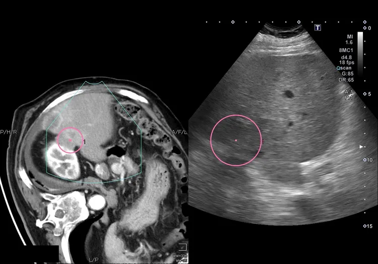醫療團隊藉由超音波及電腦斷層精準導引定位，成功完成消除肝臟腫瘤目標。亞大附醫提供