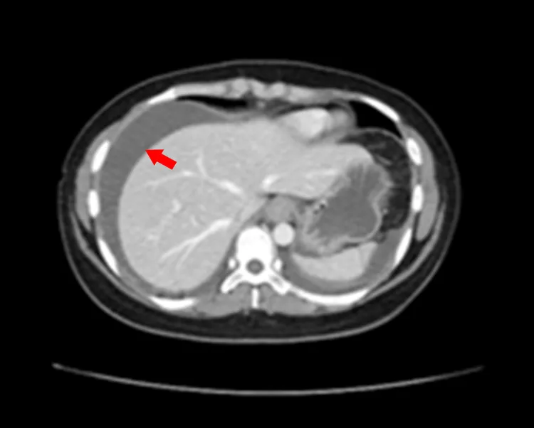 患者腹水情形嚴重（箭頭）。中港澄清醫院提供