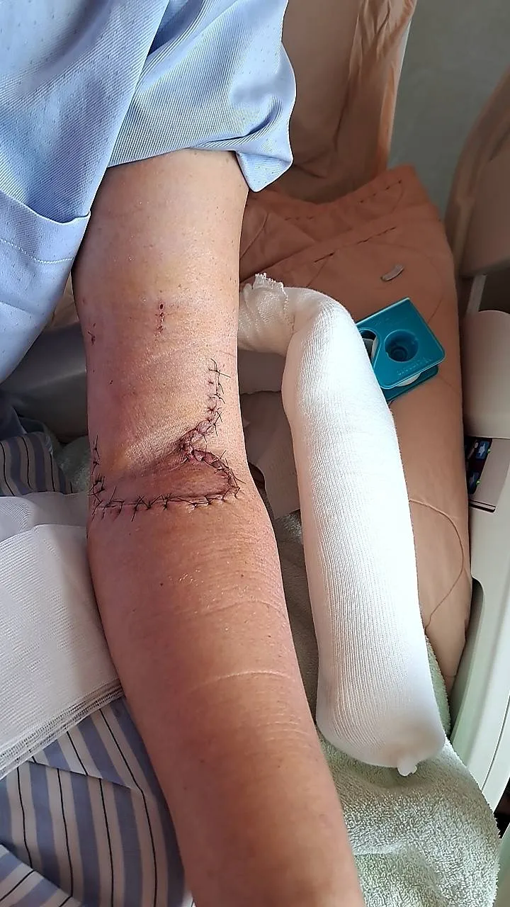 林源富出示被老婆持持利器刺傷的傷口。林源富提供