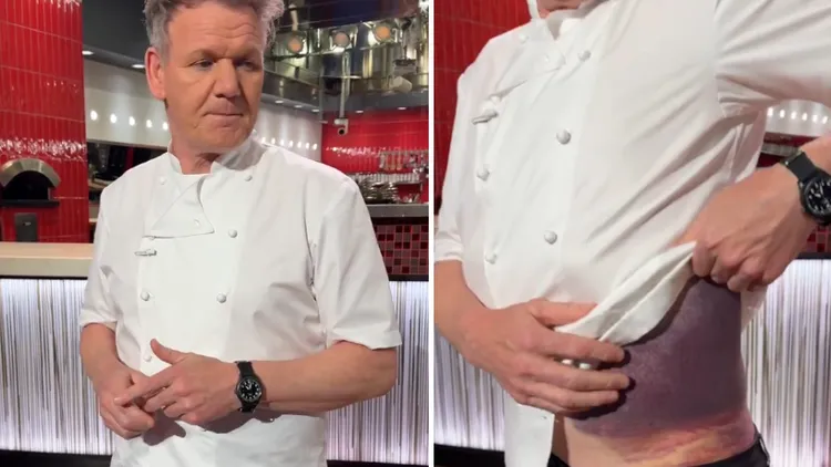 英國名廚「地獄廚神」高登拉姆齊秀出他的駭人傷勢。翻攝X@Gordon Ramsay
