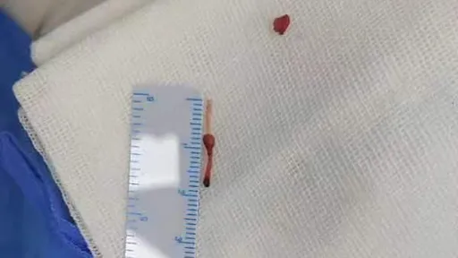 針頭導管斷在嬰兒血管裡 它「漂流5年」終於被醫生逮到了